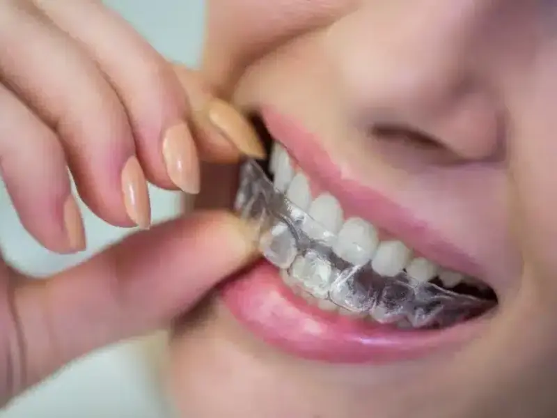 Why Choose Aligners Over Braces? - Aligners in Islamabad at Smile Center Islamabad