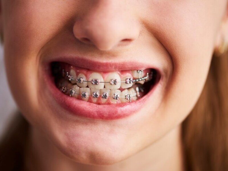 Teeth Whitening Smile Center Islamabad 3