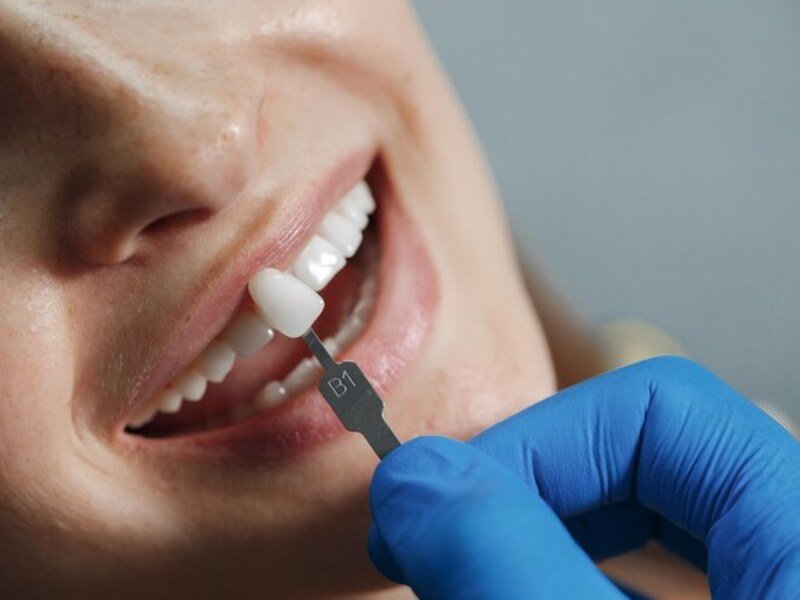 Professional Cleaning & Personalized Advice - Routine Dental Exam & Checkup at Smile Center Islamabad