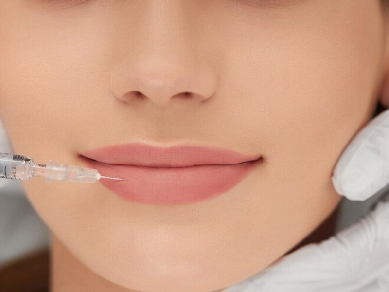 Lip Filler Treatment Smile Center Islamabad 1
