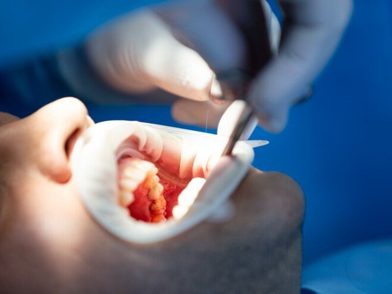 Aligners in Islamabad Smile Center Islamabad 3