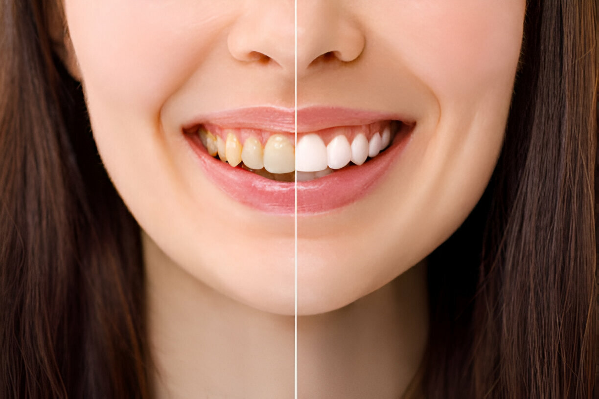 teeth whitening in islamabad