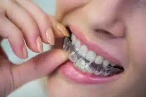aligners in Islamabad